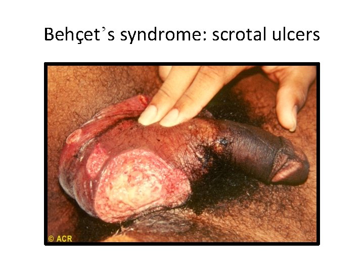 Behçet’s syndrome: scrotal ulcers 