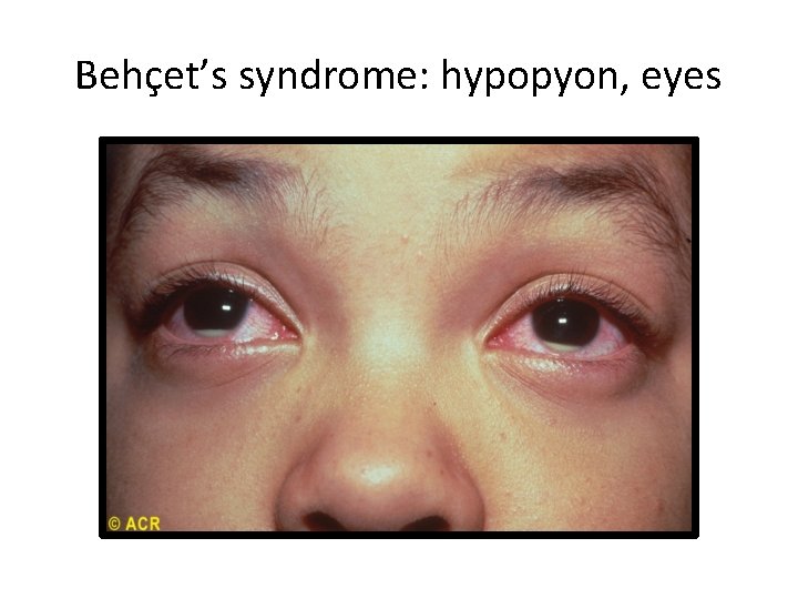 Behçet’s syndrome: hypopyon, eyes 