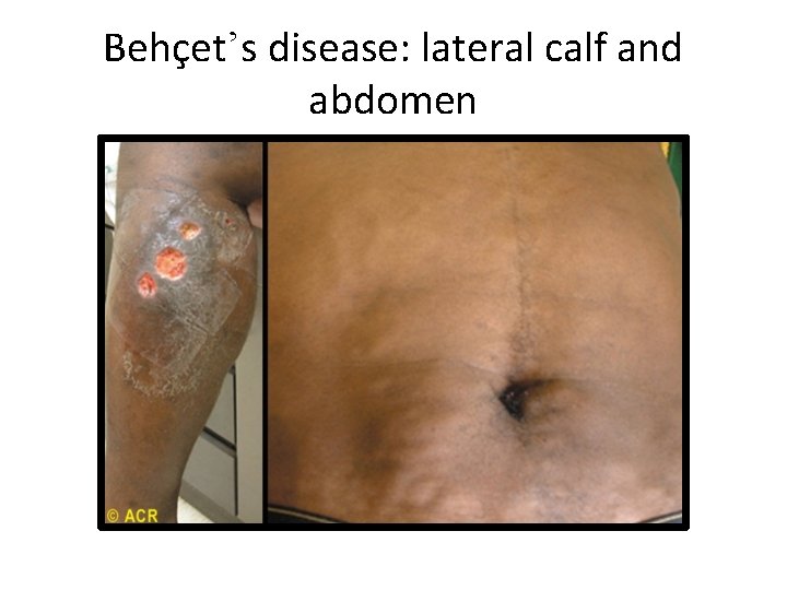 Behçet’s disease: lateral calf and abdomen 