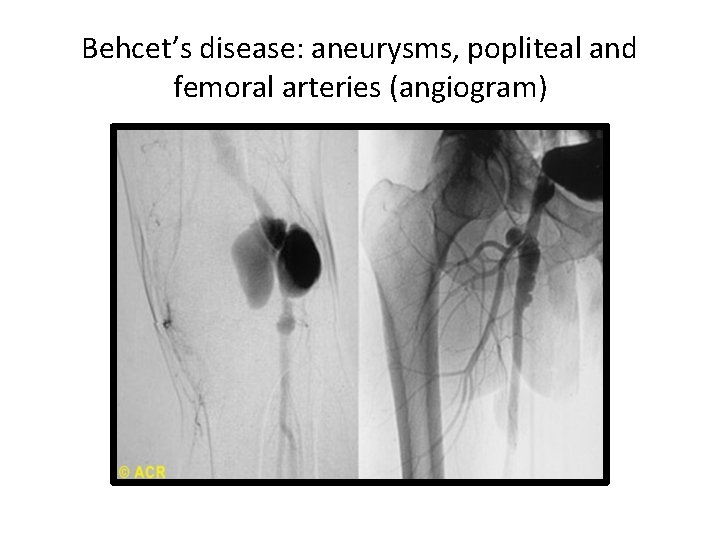 Behcet’s disease: aneurysms, popliteal and femoral arteries (angiogram) 