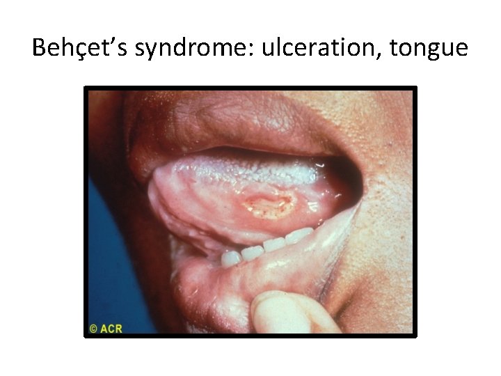 Behçet’s syndrome: ulceration, tongue 