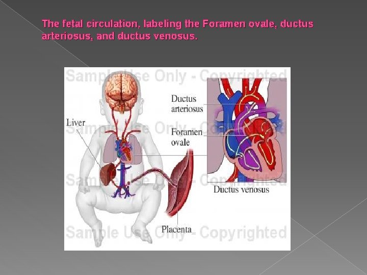 The fetal circulation, labeling the Foramen ovale, ductus arteriosus, and ductus venosus. 