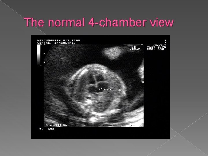 The normal 4 -chamber view 