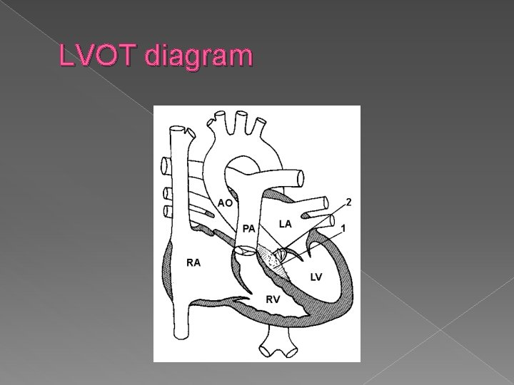 LVOT diagram 