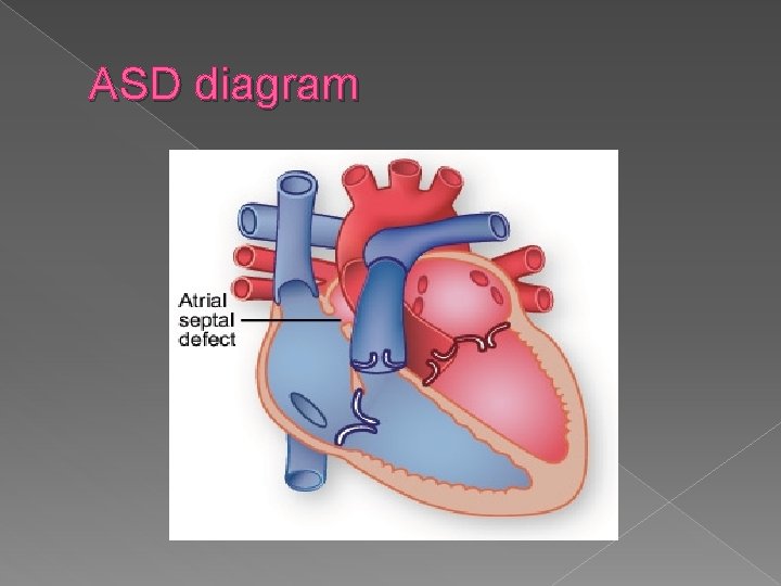 ASD diagram 