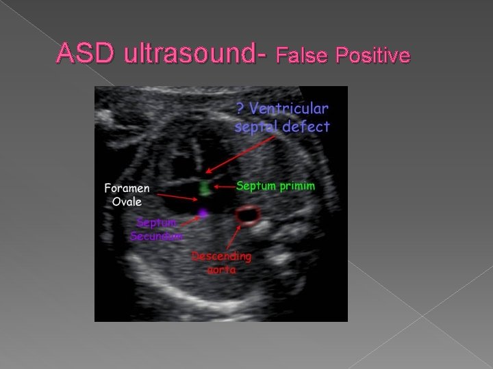 ASD ultrasound- False Positive 
