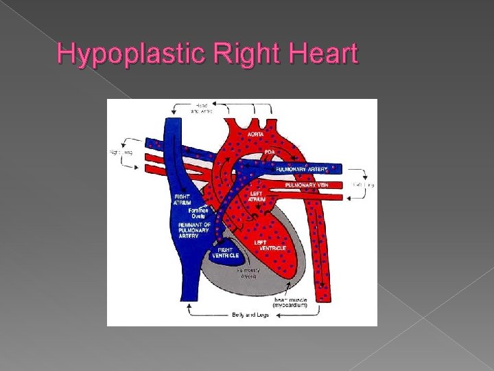 Hypoplastic Right Heart 