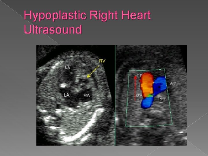 Hypoplastic Right Heart Ultrasound 