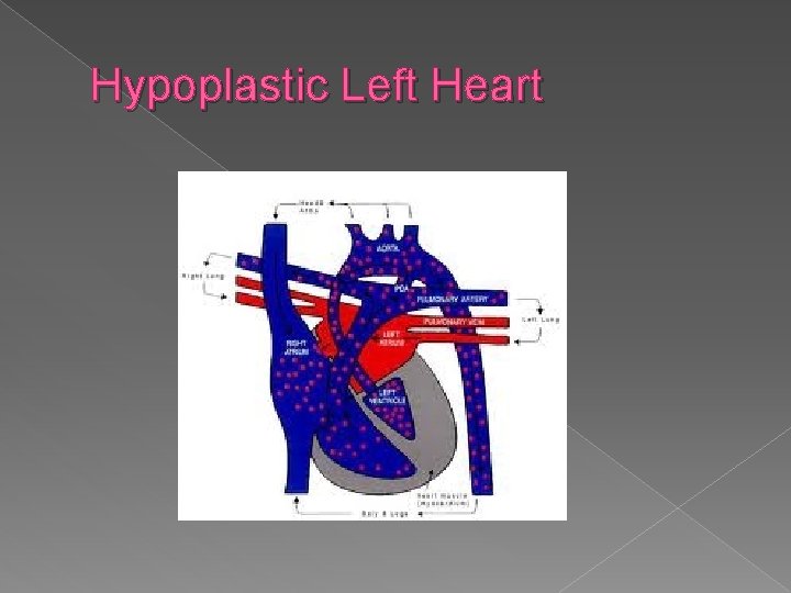 Hypoplastic Left Heart 