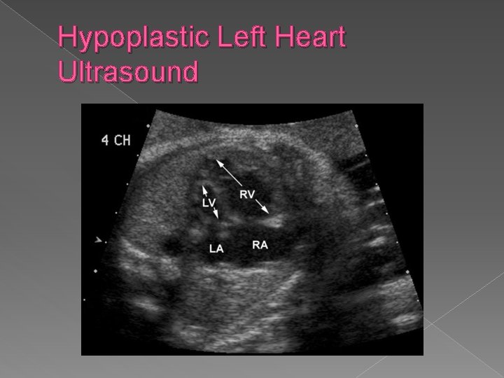 Hypoplastic Left Heart Ultrasound 