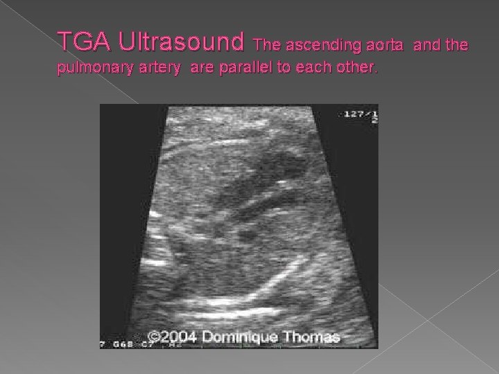 TGA Ultrasound The ascending aorta pulmonary artery are parallel to each other. and the