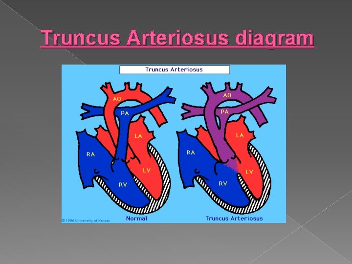 Truncus Arteriosus diagram 