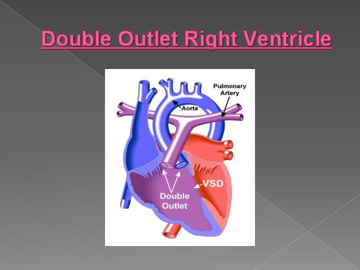 Double Outlet Right Ventricle 