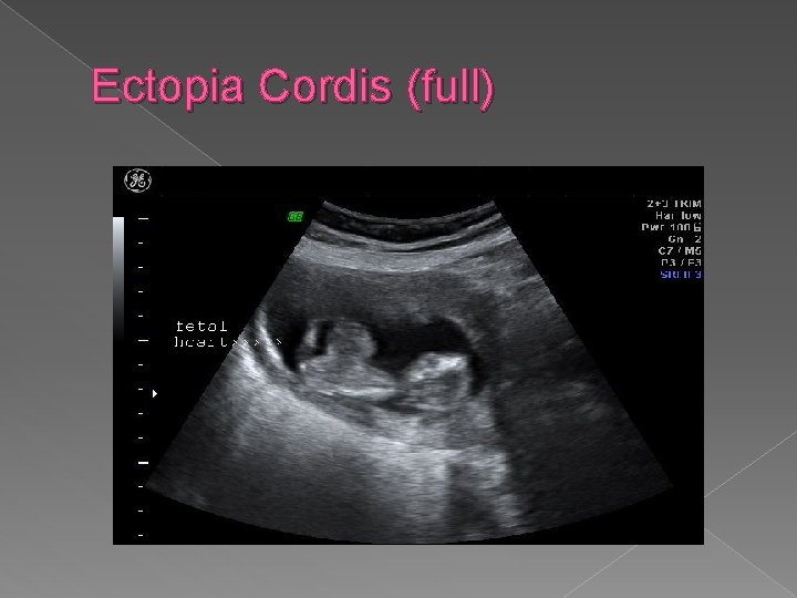 Ectopia Cordis (full) 