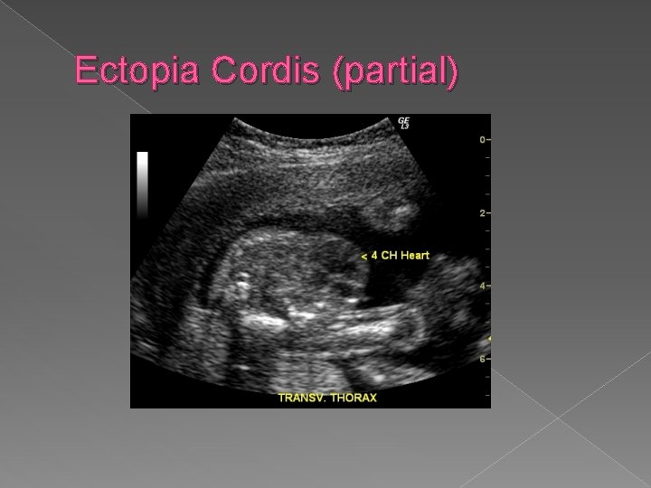 Ectopia Cordis (partial) 