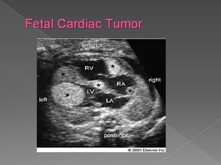 Fetal Cardiac Tumor 