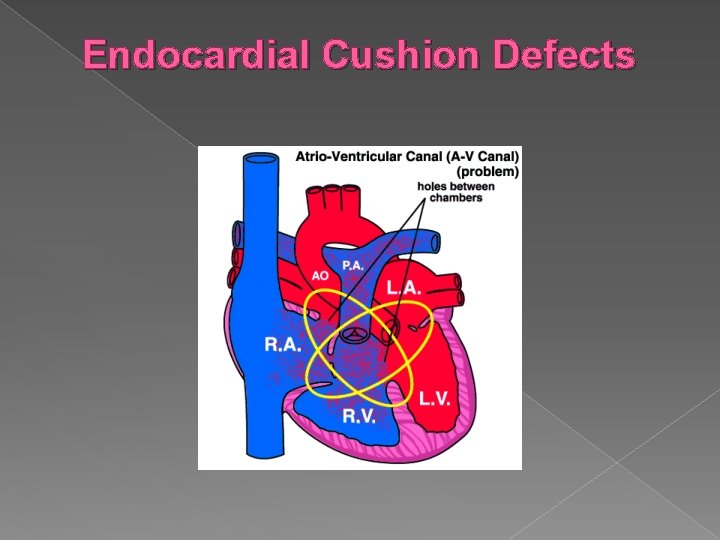 Endocardial Cushion Defects 