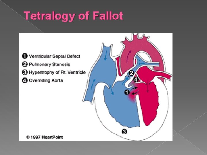 Tetralogy of Fallot 