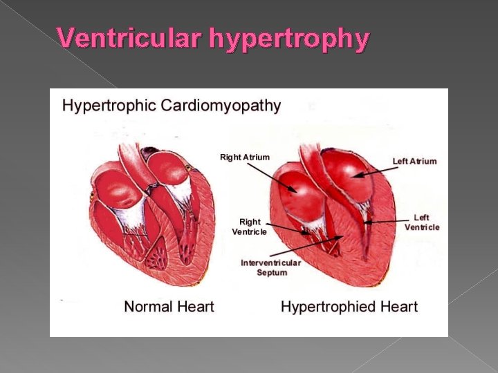 Ventricular hypertrophy 