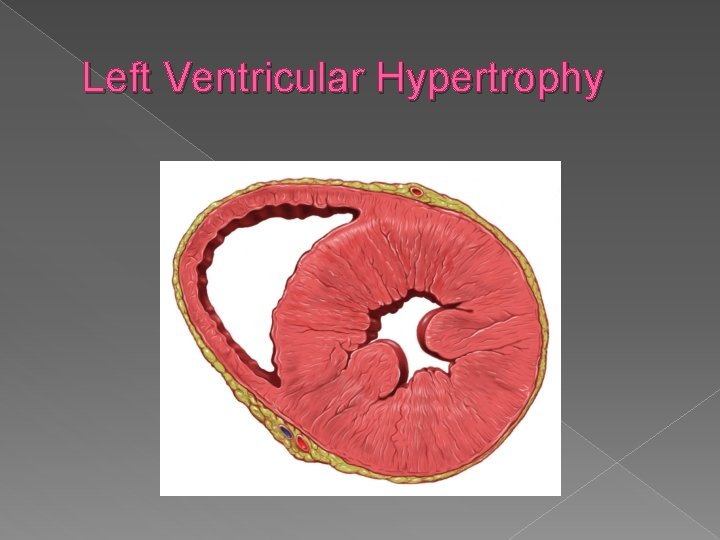 Left Ventricular Hypertrophy 
