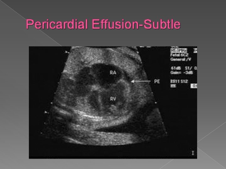 Pericardial Effusion-Subtle 