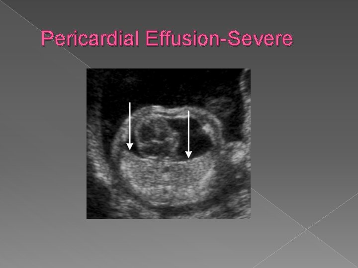 Pericardial Effusion-Severe 