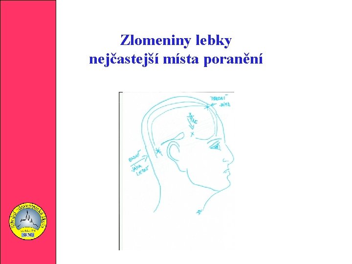 Zlomeniny lebky nejčastejší místa poranění 