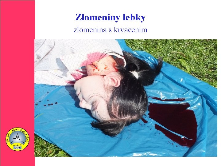 Zlomeniny lebky zlomenina s krvácením 