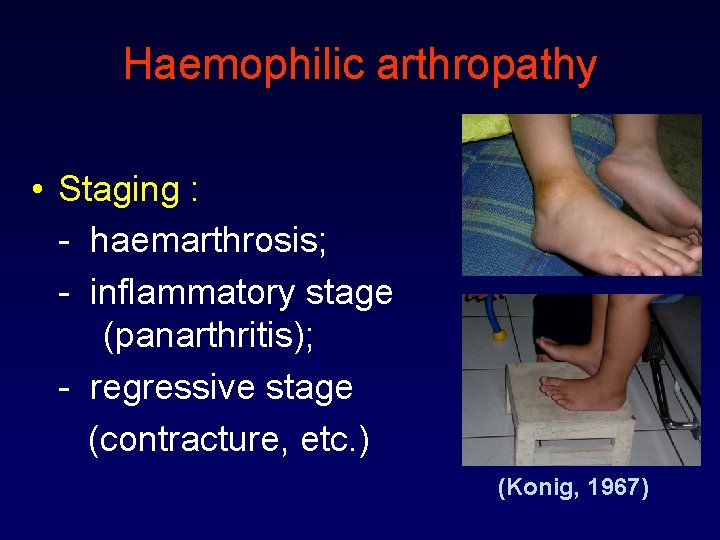Haemophilic arthropathy • Staging : - haemarthrosis; - inflammatory stage (panarthritis); - regressive stage
