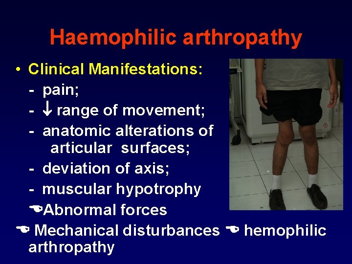 Haemophilic arthropathy • Clinical Manifestations: - pain; - range of movement; - anatomic alterations