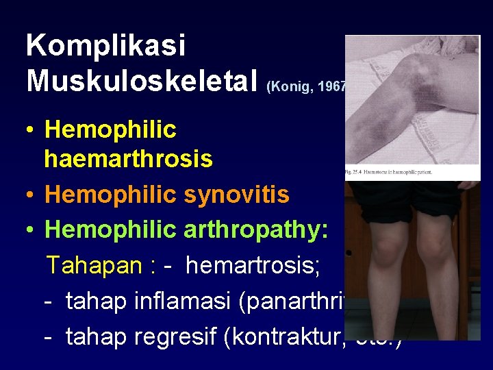 Komplikasi Muskuloskeletal (Konig, 1967) • Hemophilic haemarthrosis • Hemophilic synovitis • Hemophilic arthropathy: Tahapan