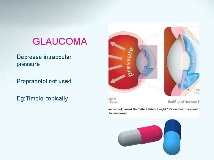 GLAUCOMA Decrease intraocular pressure Propranolol not used Eg: Timolol topically 