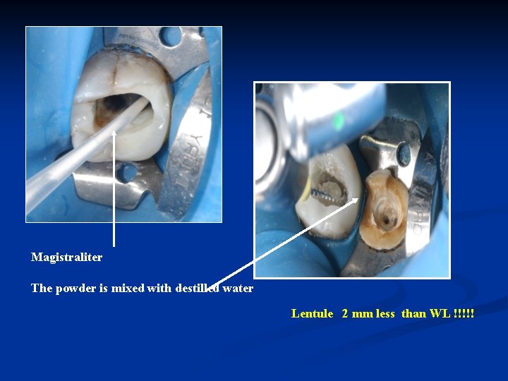 Magistraliter The powder is mixed with destilled water Lentule 2 mm less than WL