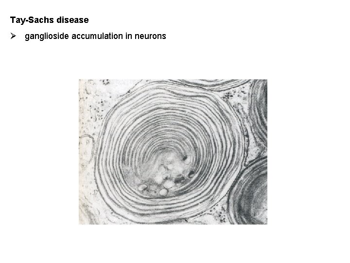 Tay-Sachs disease Ø ganglioside accumulation in neurons 