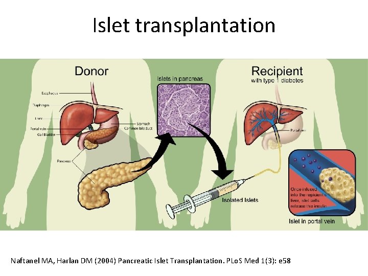 Islet transplantation Naftanel MA, Harlan DM (2004) Pancreatic Islet Transplantation. PLo. S Med 1(3):