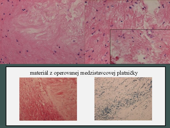 materiál z operovanej medzistavcovej platničky 