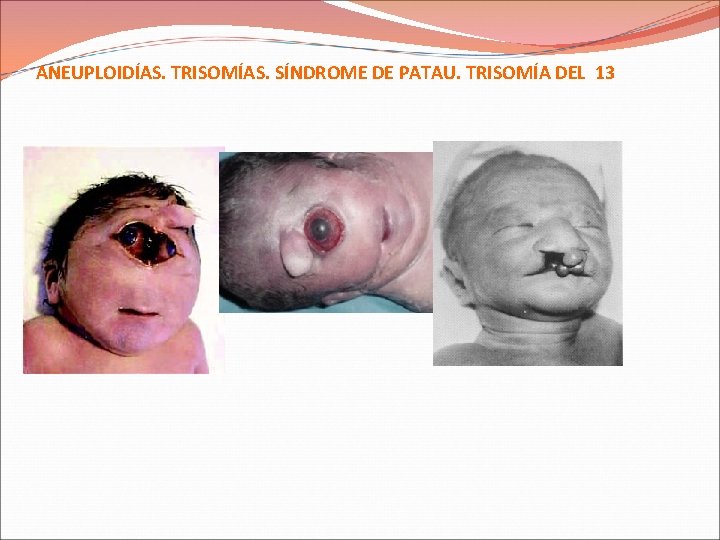 ANEUPLOIDÍAS. TRISOMÍAS. SÍNDROME DE PATAU. TRISOMÍA DEL 13 