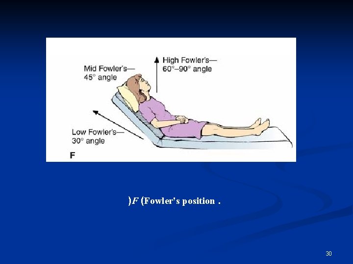 )F (Fowler's position. 30 