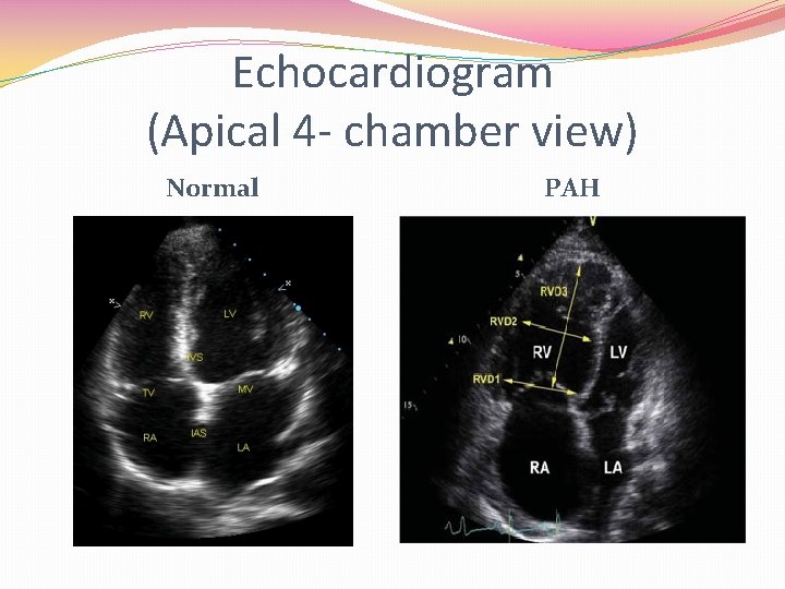 Echocardiogram (Apical 4 - chamber view) Normal PAH 