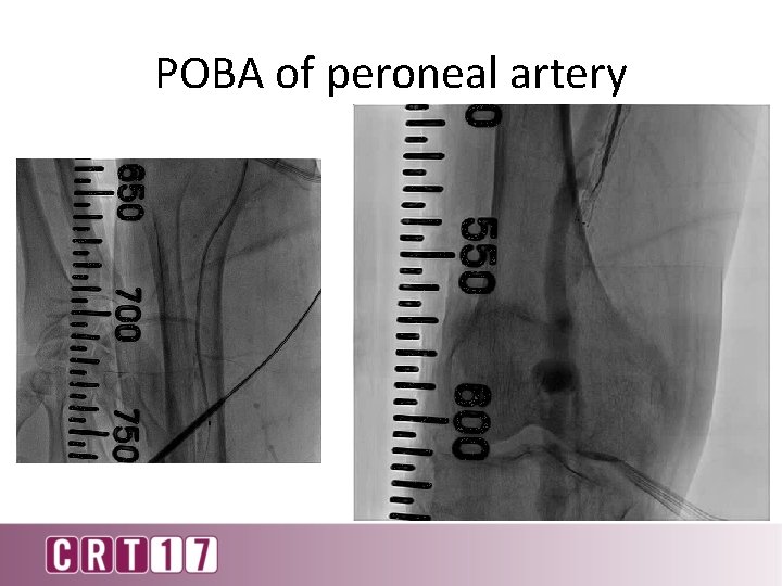 POBA of peroneal artery 