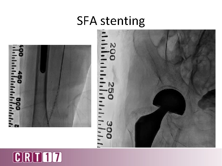 SFA stenting 