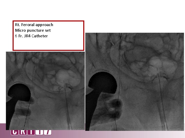 Rt. Feroral approach Micro puncture set 6 Fr. JR 4 Catheter 