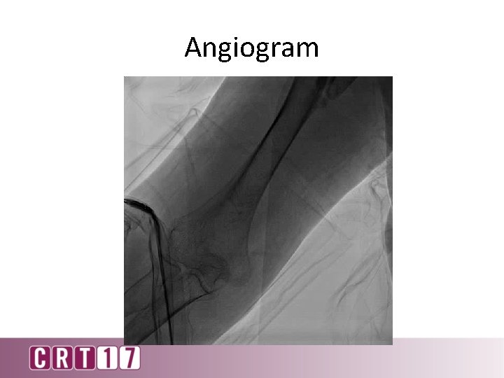Angiogram 