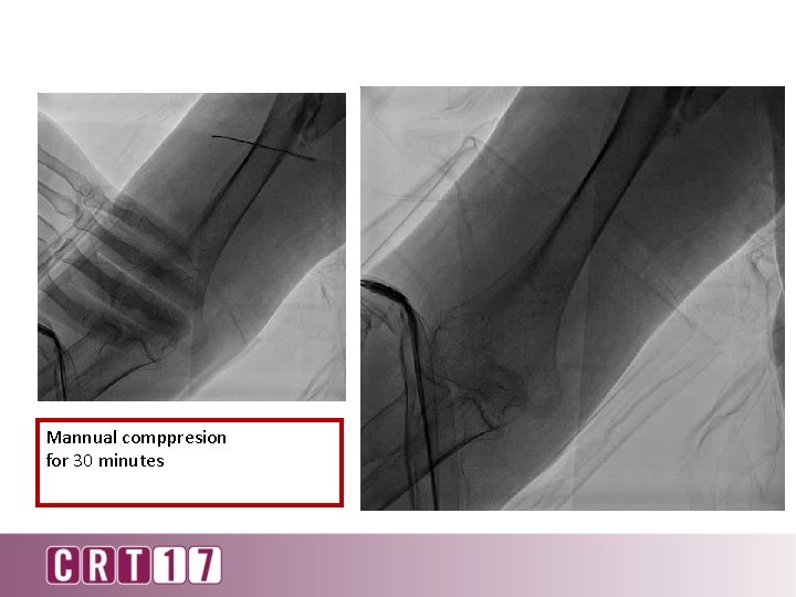 Mannual comppresion for 30 minutes 