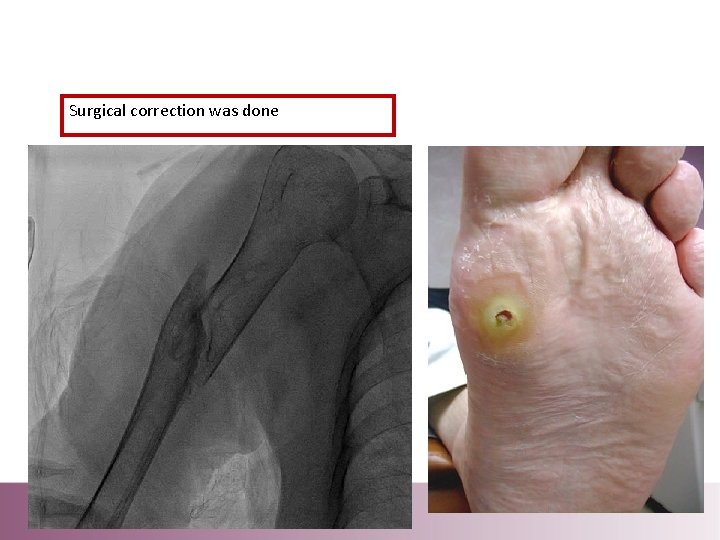 Surgical correction was done 