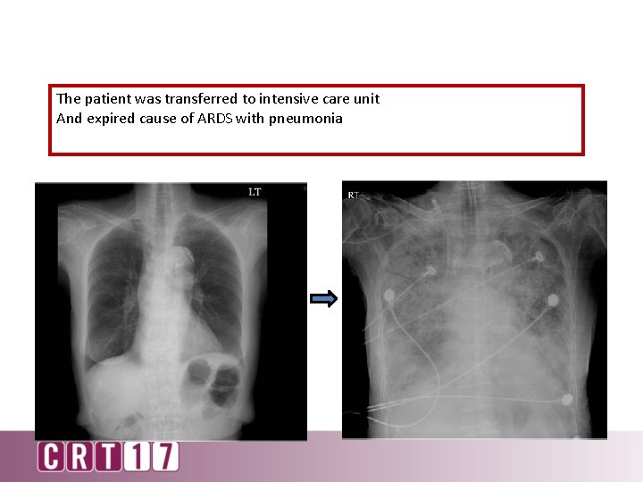 The patient was transferred to intensive care unit And expired cause of ARDS with