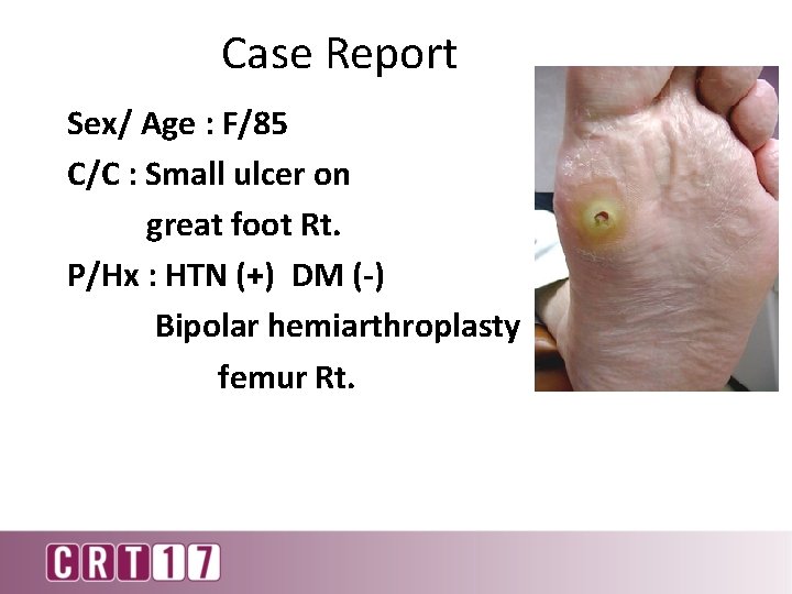 Case Report Sex/ Age : F/85 C/C : Small ulcer on great foot Rt.