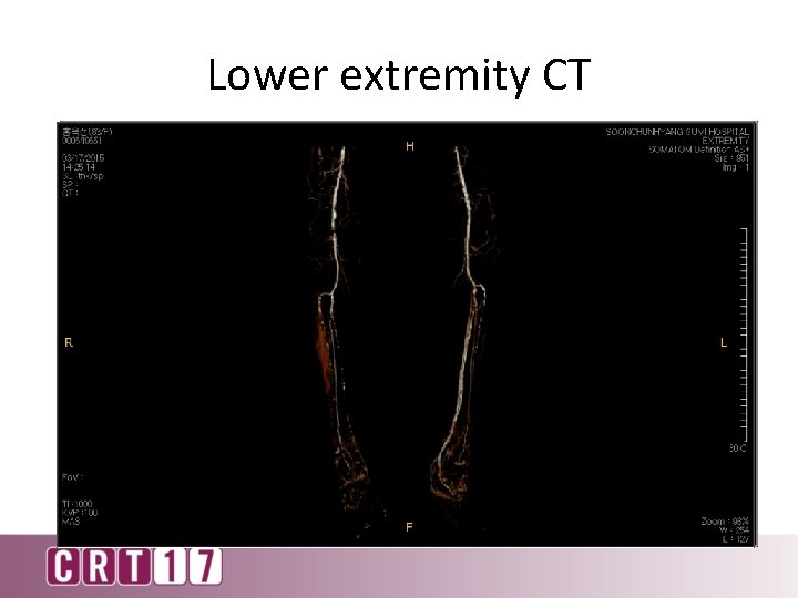 Lower extremity CT 