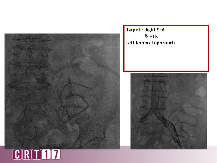 Target : Right SFA & BTK Left femoral approach 