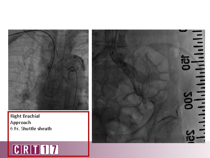 Right Brachial Approach 6 Fr. Shuttle sheath 